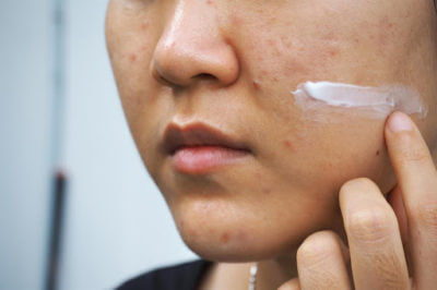 acne treatment